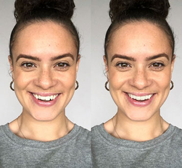 invisalign® smile