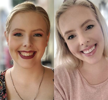 invisalign® smile