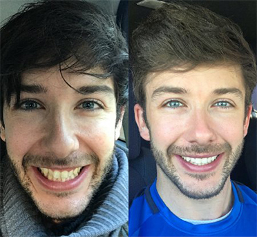 invisalign® smile