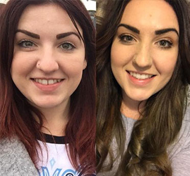 invisalign® smile