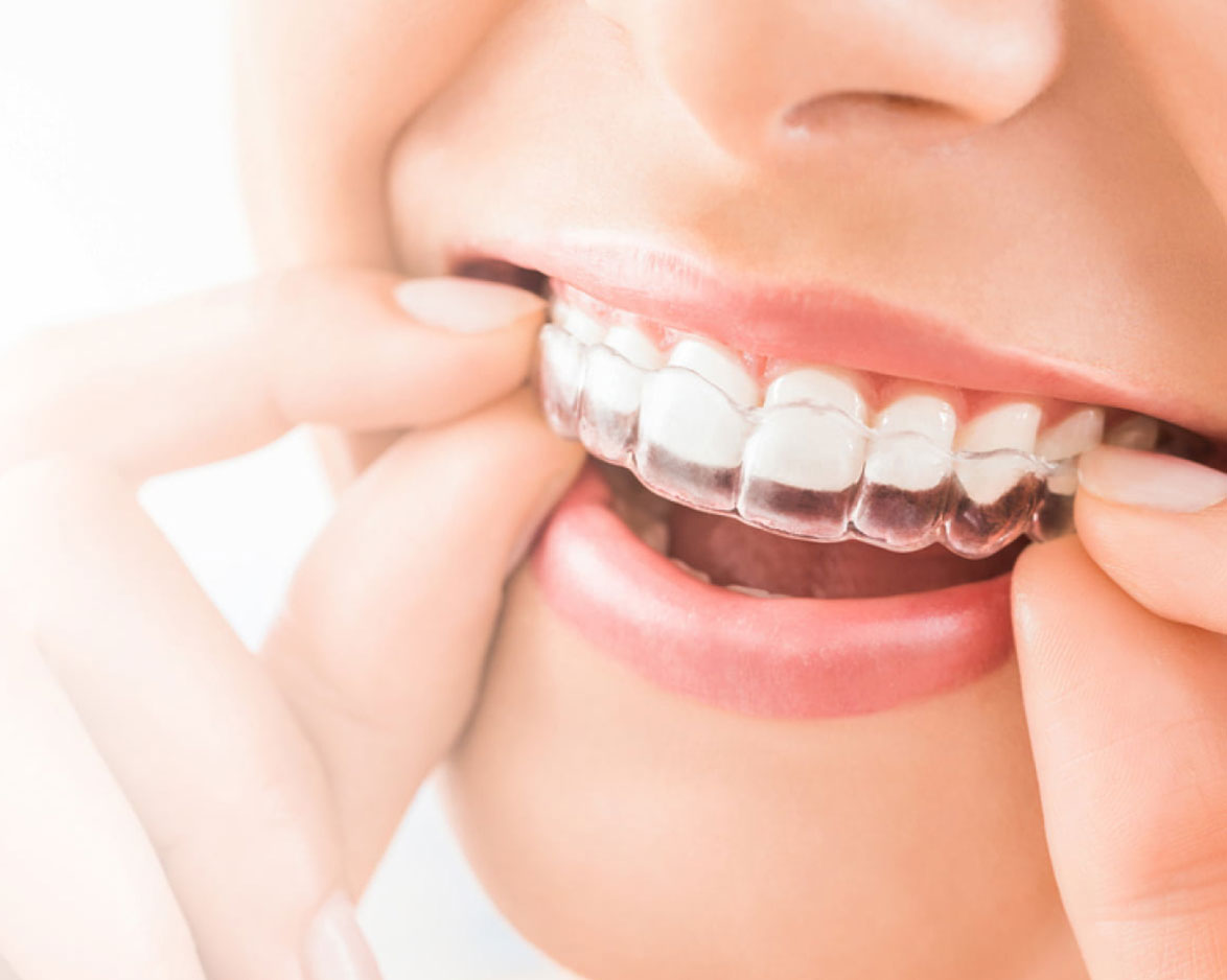 invisalign® clear aligners