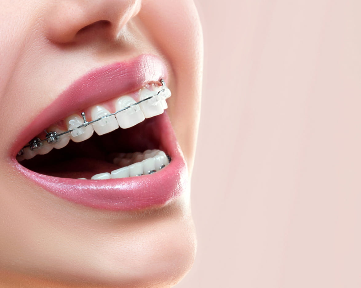 invisalign® wire brace